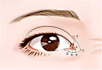 A comparative retrospective analysis: myocutaneous flap versus skin flap in V-Y medial epicanthal fold reconstruction